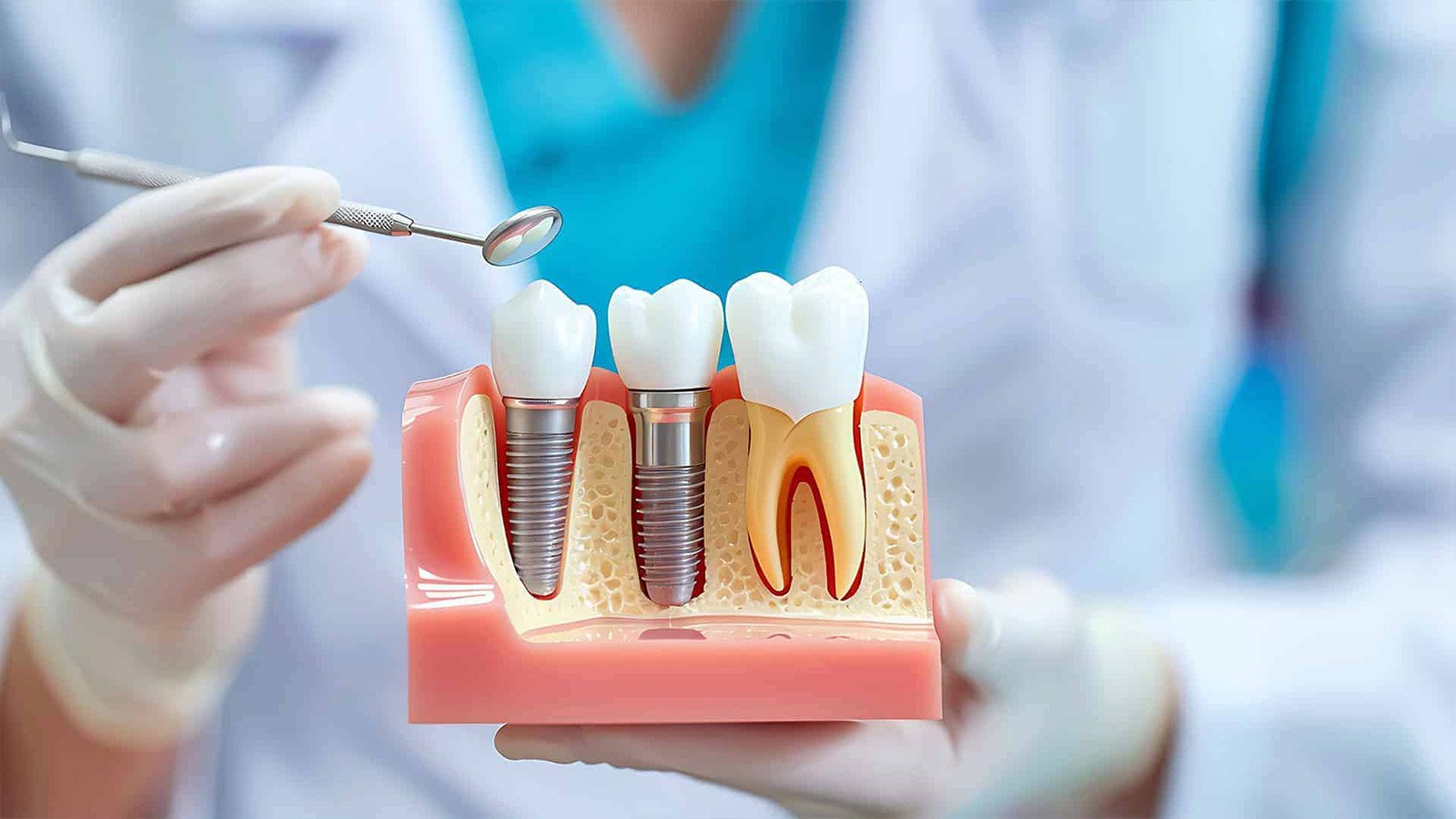 Dental Implants